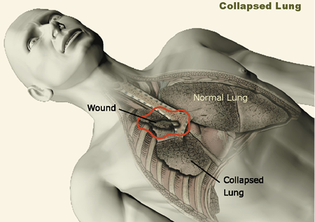 pneumothorax